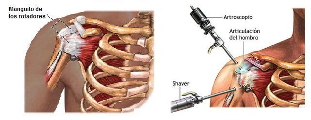Lesión del manguito rotador