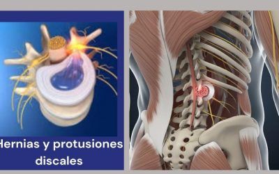 Causas de las herniales discales