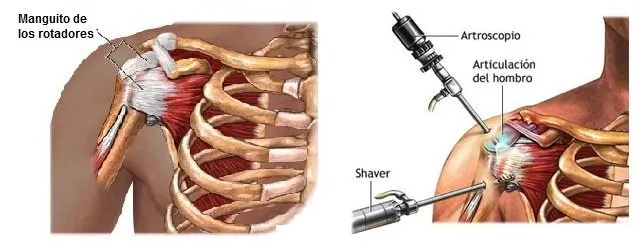 Lesión del manguito rotador