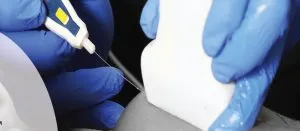 Epi - Electrólisis Percutánea Intratisular