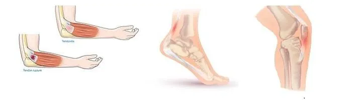 TENDINITIS O TENDINOPATIA