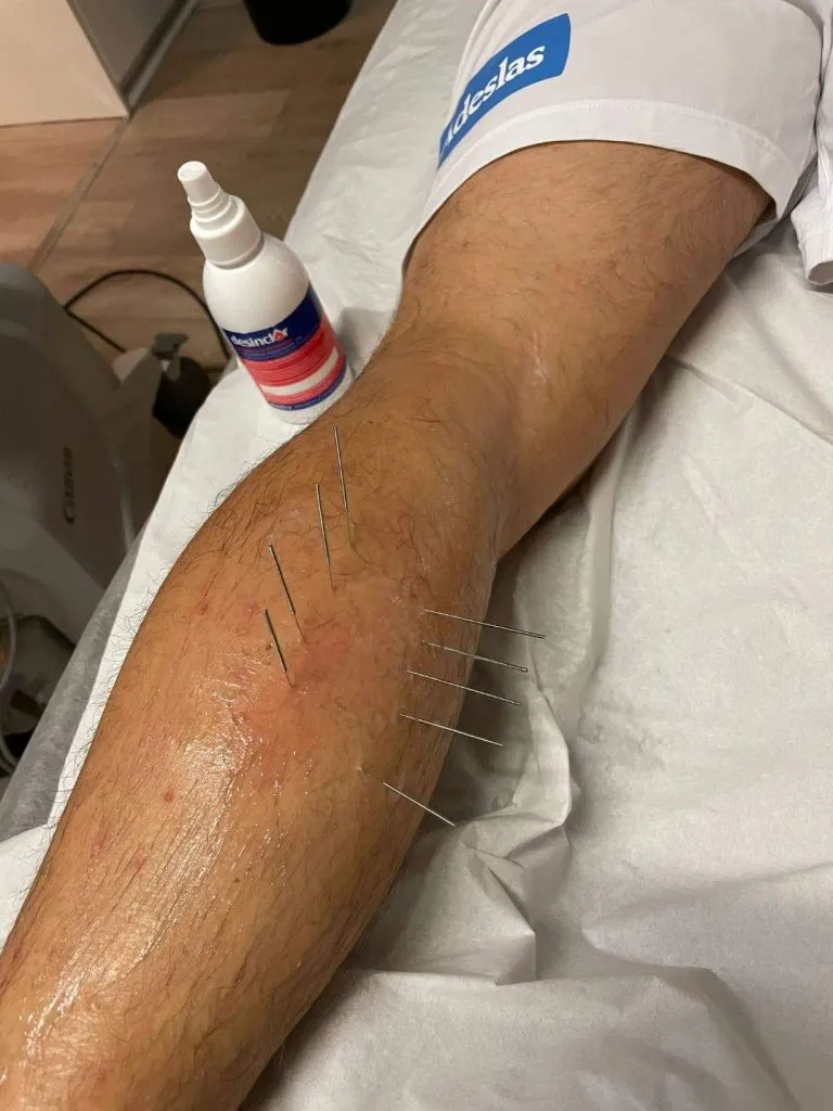 rotura gemelo belasategui