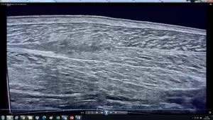 rotura gemelo ecograf