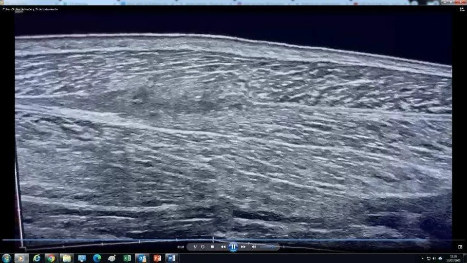 rotura gemelo ecograf