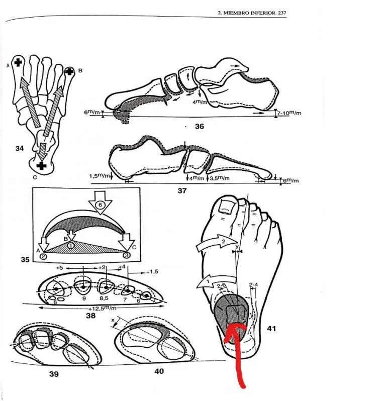 consecuencias del esguince de tobillo