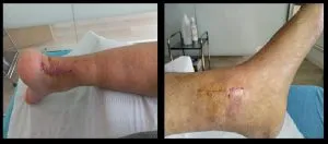 intervención en esguince de tobillo