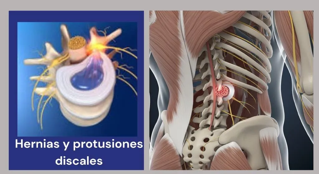 hernias_y_protusiones_discales hernias_y_protusiones_discales